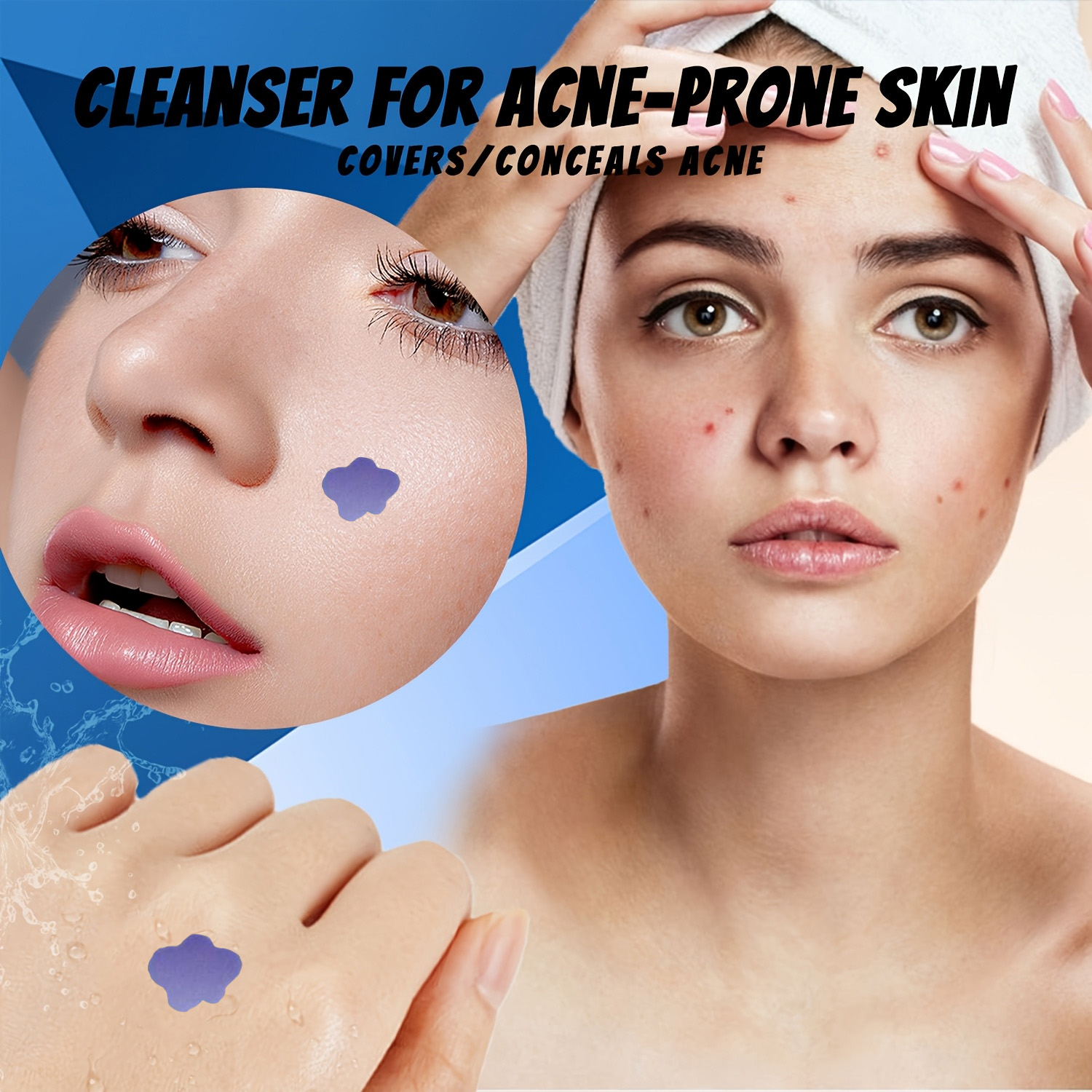 لاصقات علاج حب الشباب بالمايكر - مراجعة Skincare You وسعره
