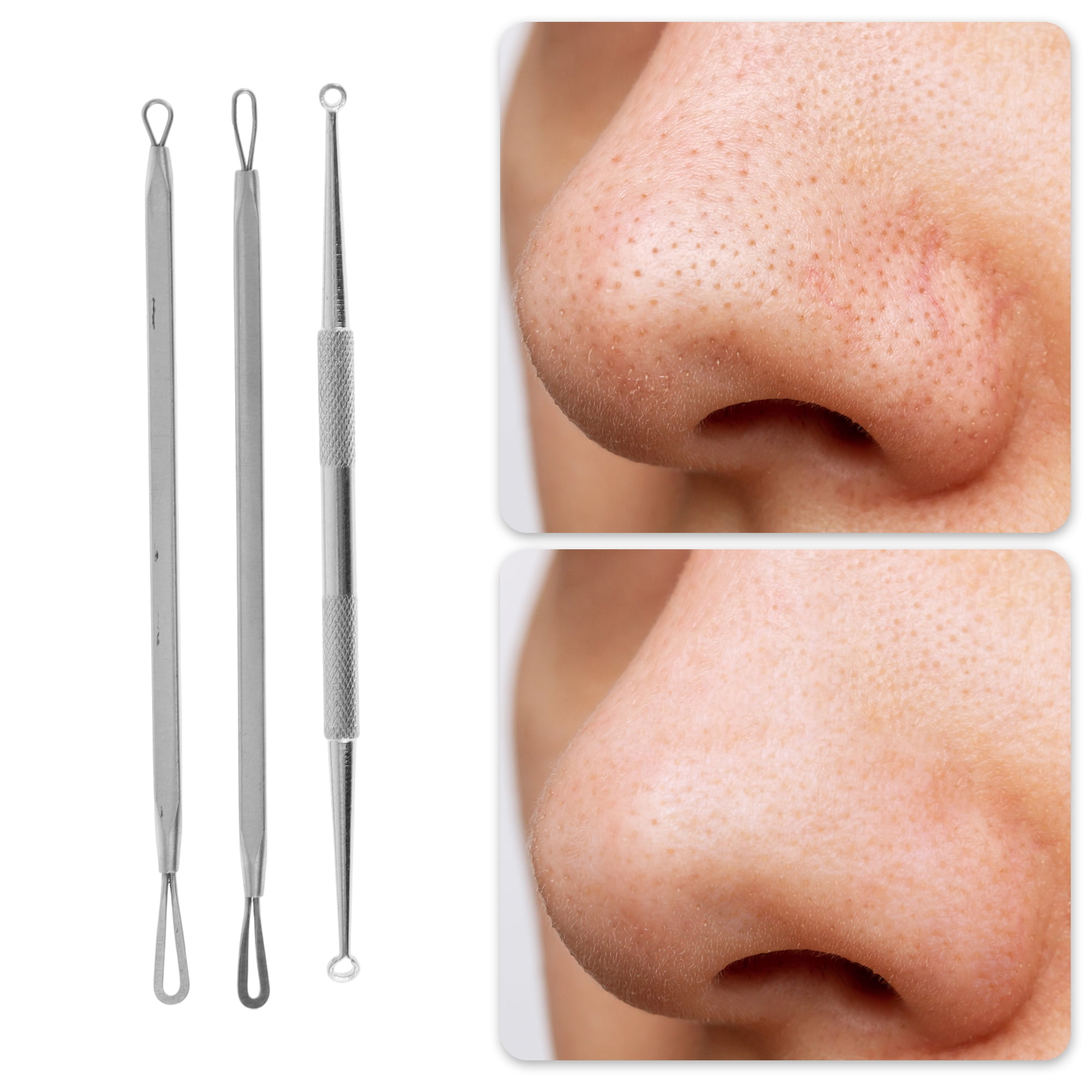 مجموعة أدوات احترافية لإزالة ا - مراجعة Skincare You وسعره